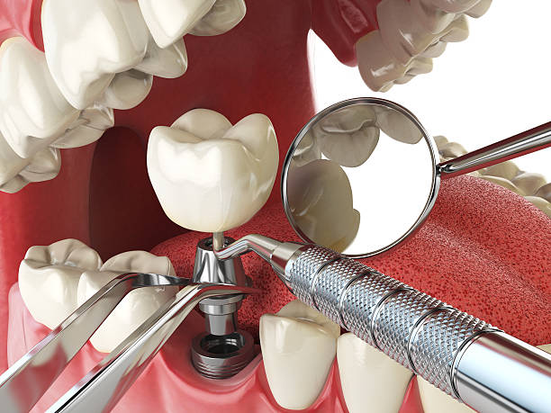 Best Emergency Wisdom Teeth Removal in Four Bridges, OH